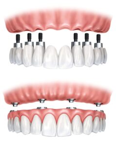 Dental Implants: The Difference Between StandardImplants, Bone Grafting, and Zygomatic Implants
