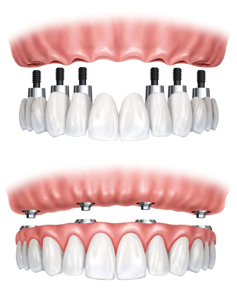 Dental Implants: The Difference Between StandardImplants, Bone Grafting, and Zygomatic Implants